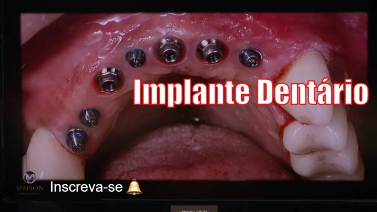 Implante Dent&aacute;rio: Tudo Sobre o Procedimento