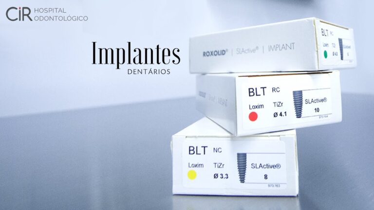 Os Melhores Implantes Dentários: Guia Completo