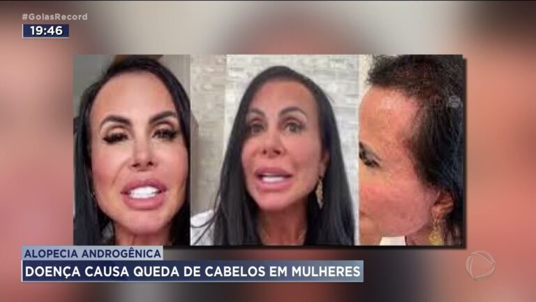 Tratamento eficaz para alopecia androgen&eacute;tica feminina