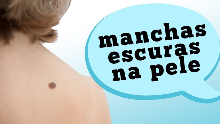 Sinais de pele pretos: o que precisamos saber