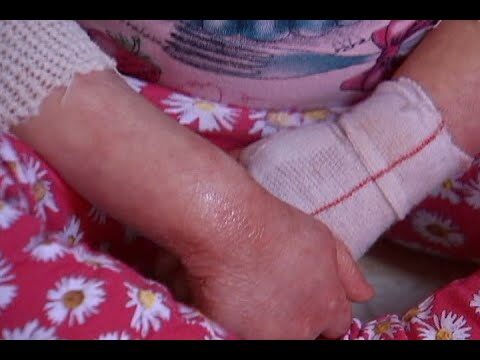Doenças de Pele Contagiosas: Prevenção e Tratamento